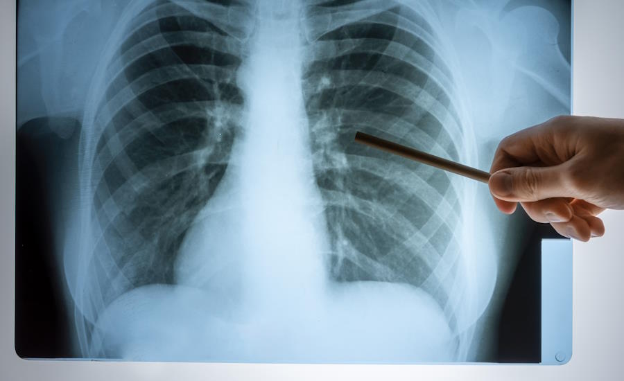 alltifrån astma till lungcancer kan bli aktuellt vid frekvent inandning av svetsrök något som är mycket värt att tänka på innan man utsätter sig för risken